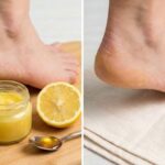 Quick Home Method Helps Heal Dry Cracked Heels Fast Using Simple Kitchen Ingredients
