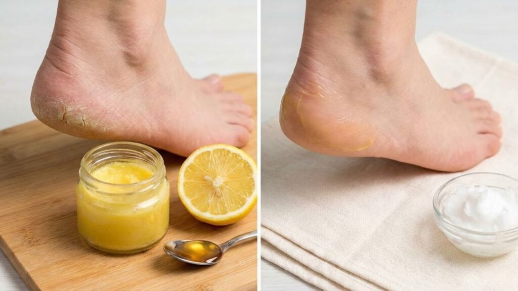 Heal Dry Cracked Heels
